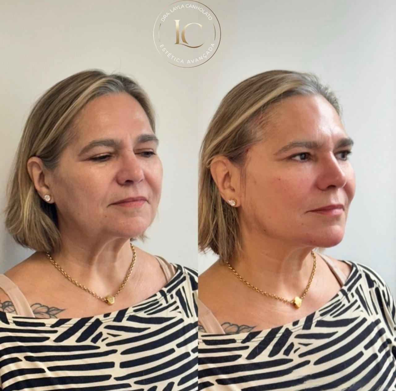 Antes e depois de paciente do Método Time Reverse 2