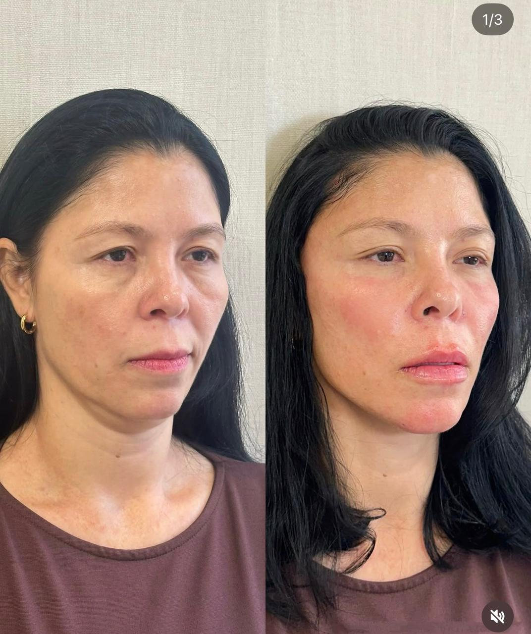 Antes e depois de paciente do Método Time Reverse 5