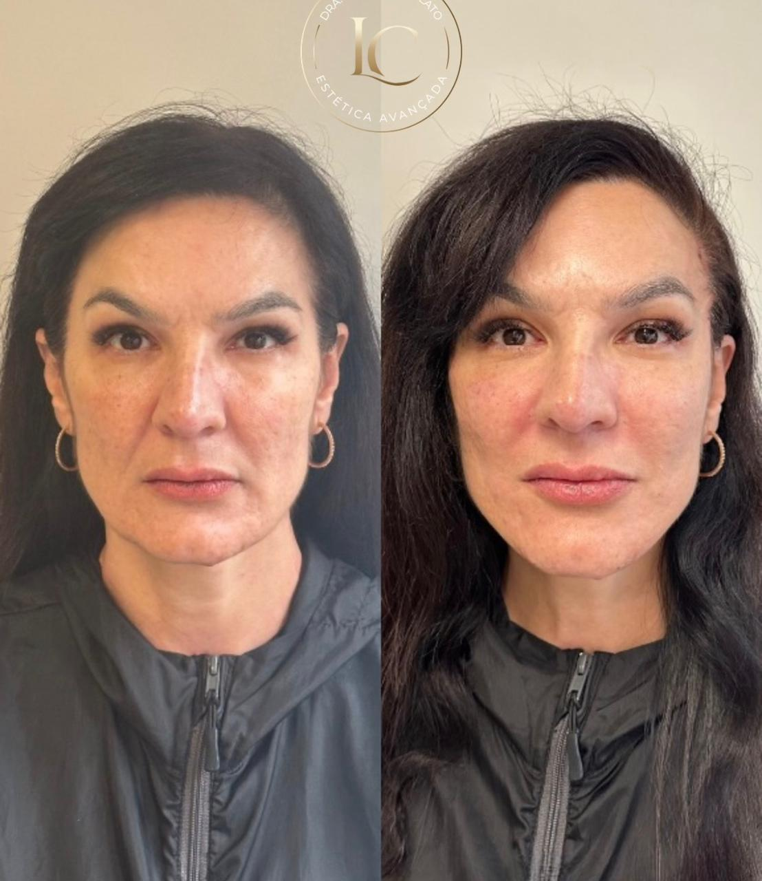 Antes e depois de paciente do Método Time Reverse 1