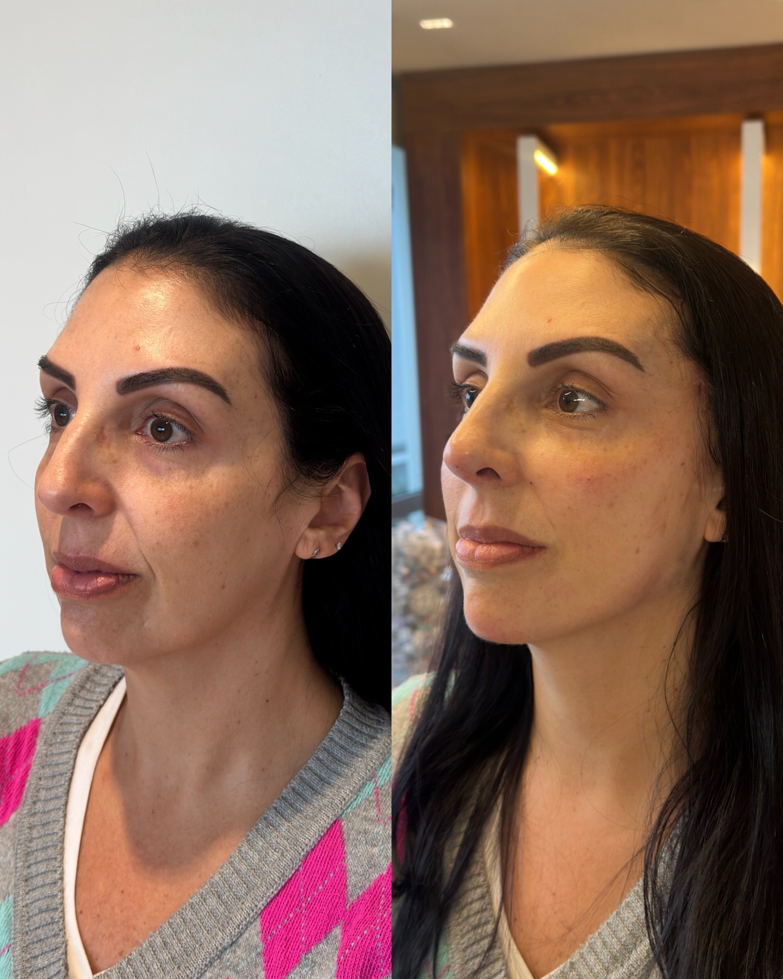 Antes e depois de paciente do Método Time Reverse 6