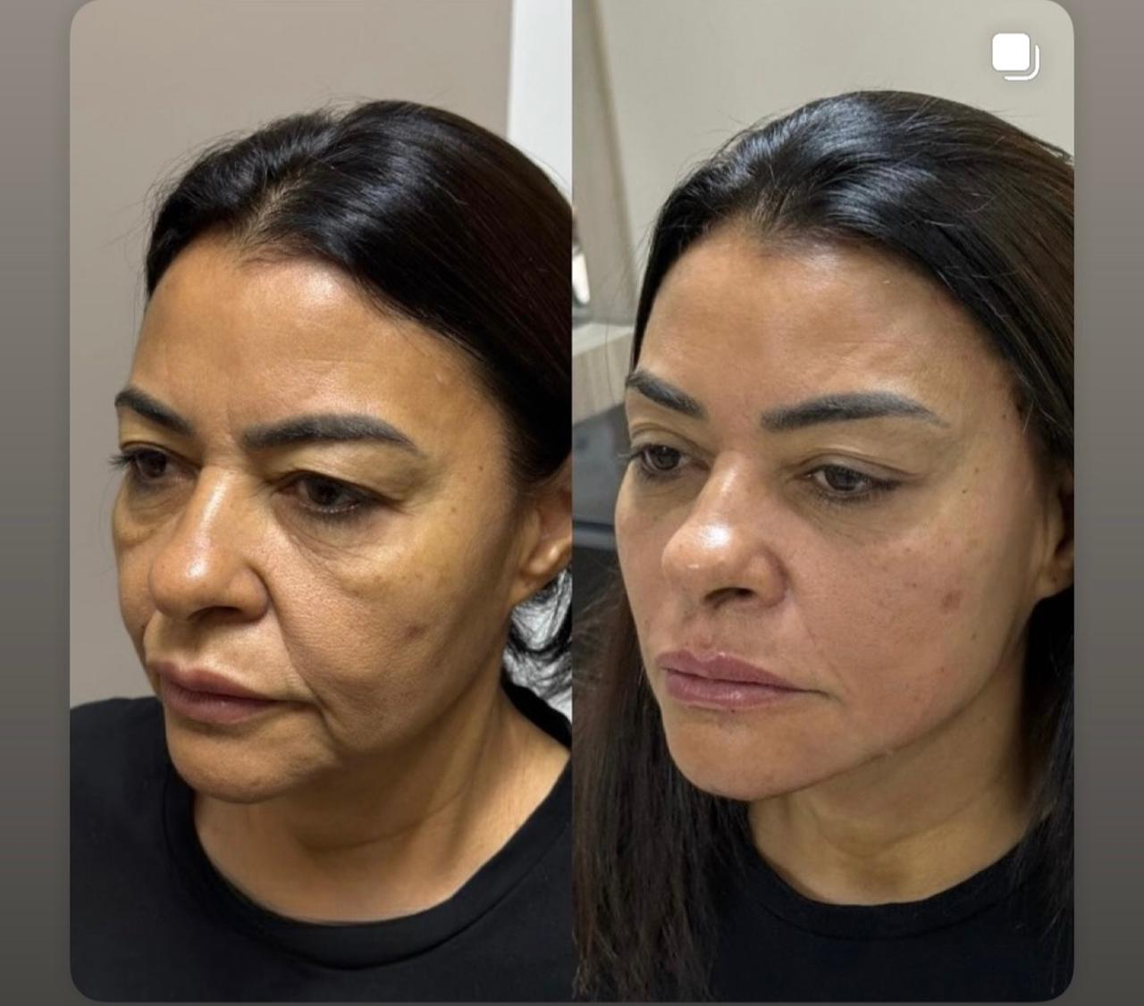 Antes e depois de paciente do Método Time Reverse 3