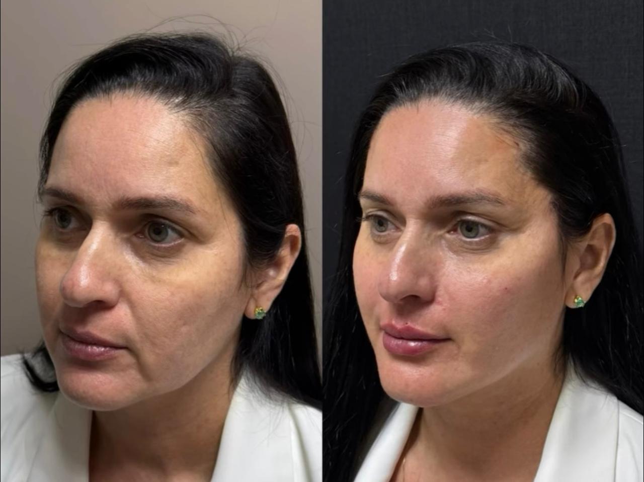 Antes e depois Método Time Reverse 4
