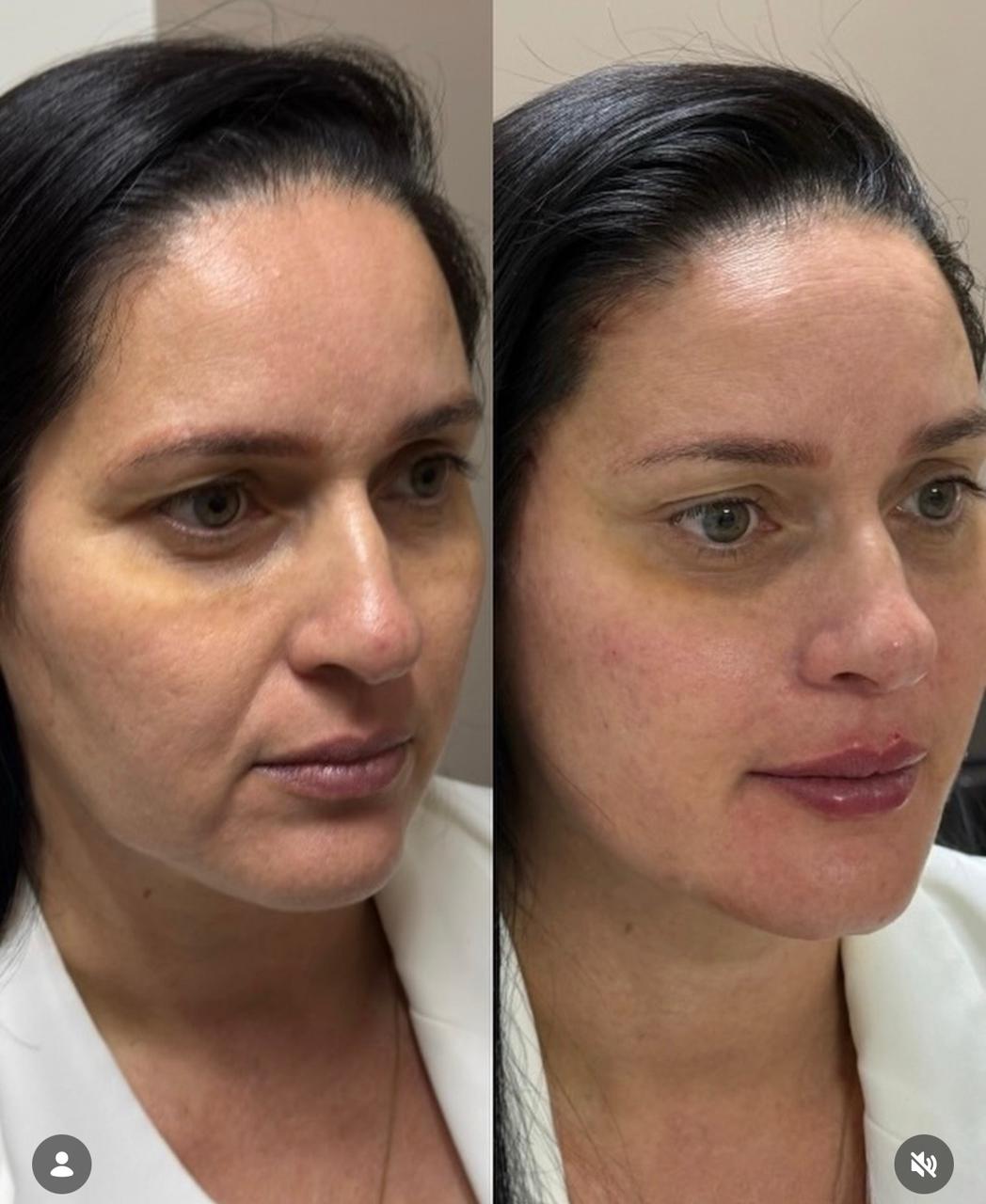 Antes e depois Método Time Reverse 5